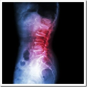 Back Pain Sioux Falls SD Arthritis