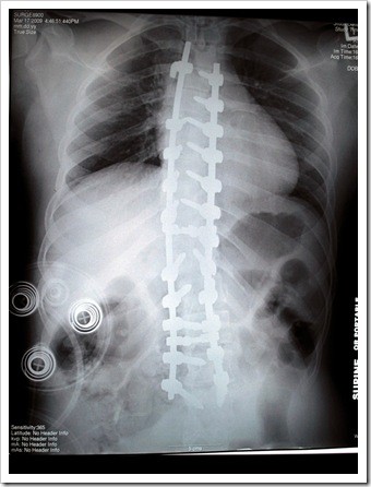 Sioux Falls Scoliosis