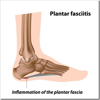 Foot Pain Sioux Falls SD Plantar Fasciitis