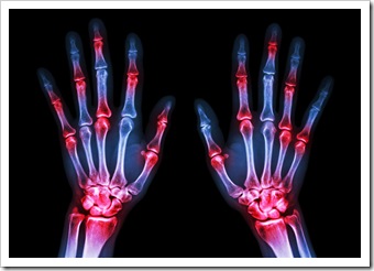 Rheumatoid Sioux Falls SD Arthritis Solutions