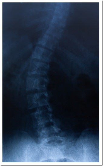 Sioux Falls Scoliosis Treatment